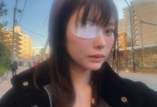 变成独眼龙!松本丽铃(原 明日见未来)被前男友打到受伤。-优优日报