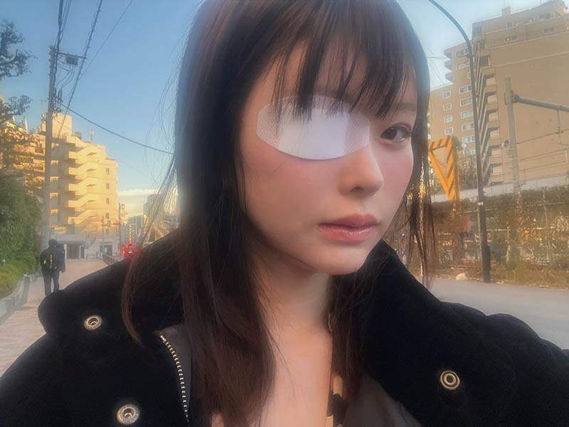 变成独眼龙!松本丽铃(原 明日见未来)被前男友打到受伤。