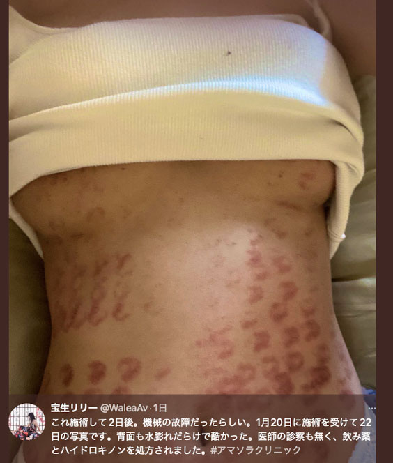 女优「宝生莉莉」做除毛手术 院方出包让她严重烧伤...可怕画面曝光