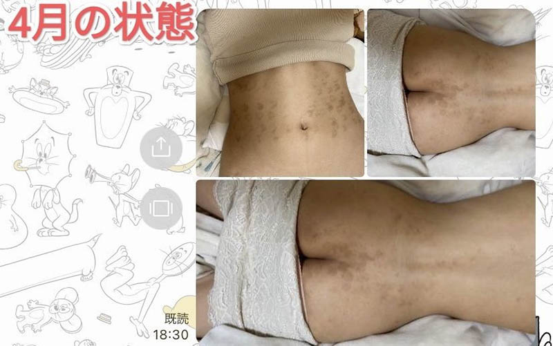 女优「宝生莉莉」做除毛手术 院方出包让她严重烧伤...可怕画面曝光